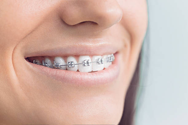 Best Traditional Braces  in Avimor, ID